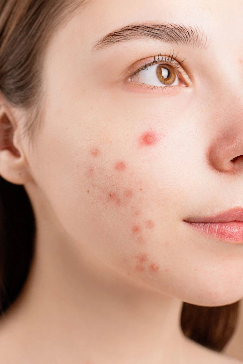 Phát ban mụn trứng cá là gì?3