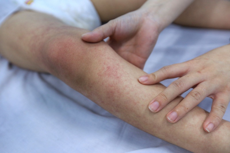 Phát ban sốt xuất huyết bao lâu thì khỏi?2