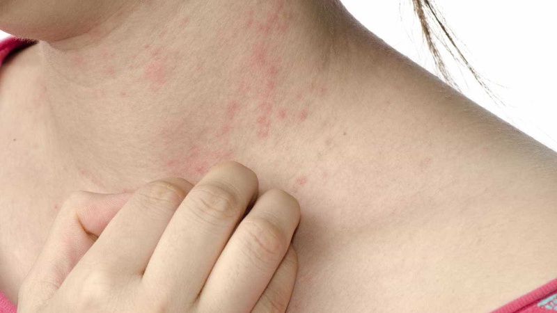 Sốt phát ban và sởi khác nhau như thế nào 2