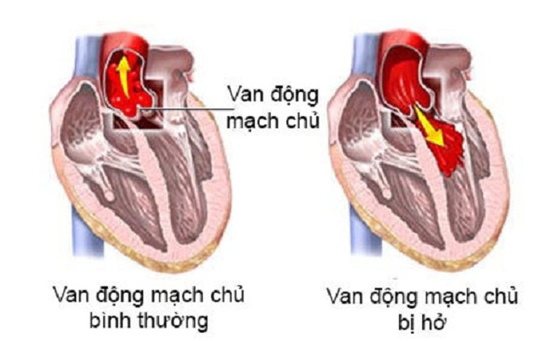 Phẫu thuật bentall điều trị bệnh lý về gốc động mạch chủ 1