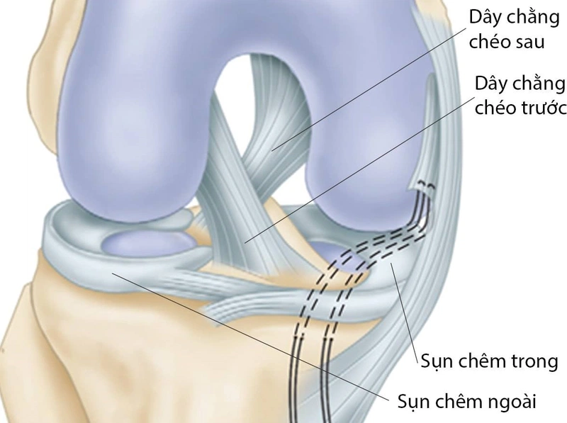 Phẫu thuật dây chằng chéo trước gối được thực hiện như thế nào? 1