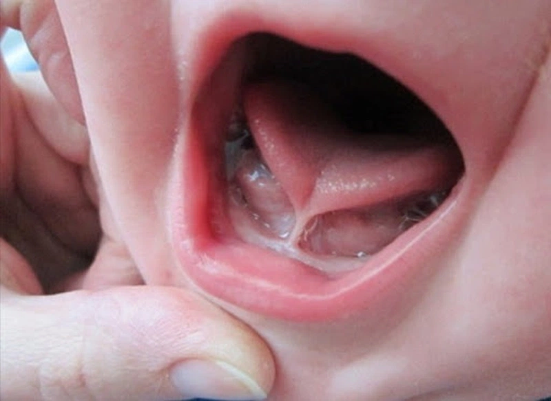 Phẫu thuật dính thắng lưỡi ở trẻ em có gây nguy hiểm? 1