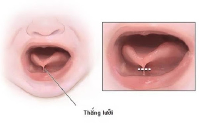 Phẫu thuật dính thắng lưỡi ở trẻ em có gây nguy hiểm? 2