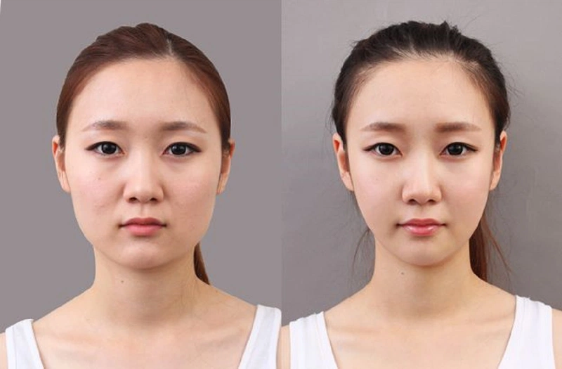 Phẫu thuật hạ gò má có đau không? 1