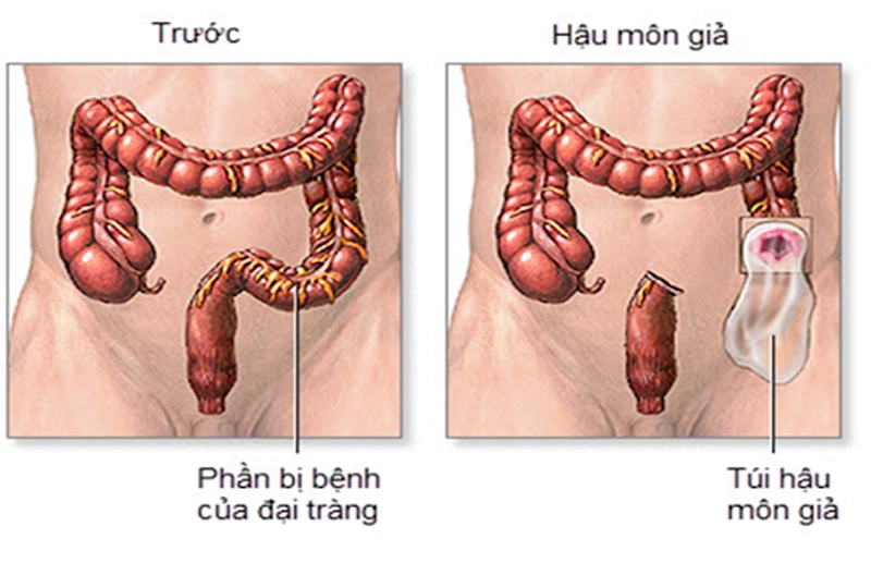 Phẫu thuật làm hậu môn nhân tạo 1