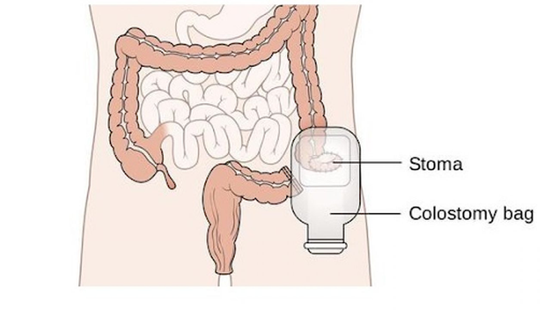 Phẫu thuật làm hậu môn nhân tạo 2