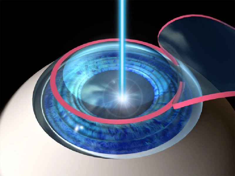 Phẫu thuật Lasik mắt là gì? 1