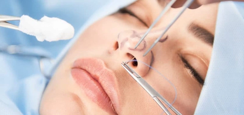 Nâng mũi sụn tai có tốt không và biến chứng nâng mũi sụn tai thường gặp 2