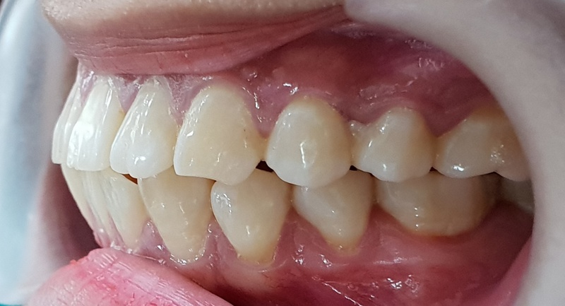 Phẫu thuật răng hô và cách chăm sóc sau phẫu thuật 1