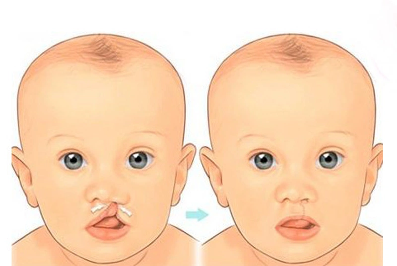 Phẫu thuật sứt môi: Những điều cần biết 2