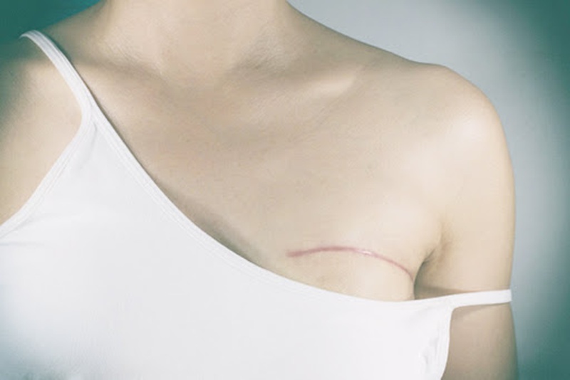 Phẫu thuật tạo hình trong điều trị ung thư 3