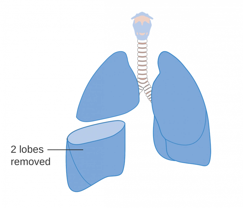 Phẫu thuật ung thư phổi như thế nào?3