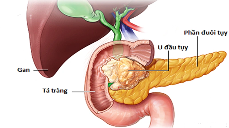 Phẫu thuật whipple diễn ra như thế nào1