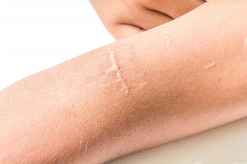 Phẫu thuật xóa sẹo trắng: Ưu điểm và lưu ý 1