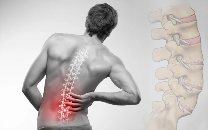 Phồng đĩa đệm L4/L5 là gì? Bệnh phồng đĩa đệm L4/L5 có chữa được không? 3