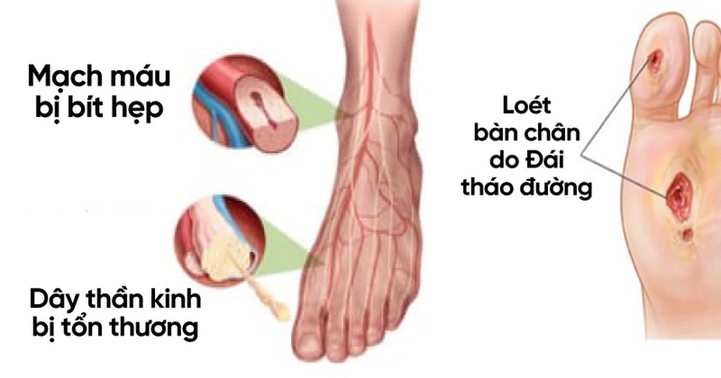 Phòng ngừa tê bì chân tay ở người tiểu đường3