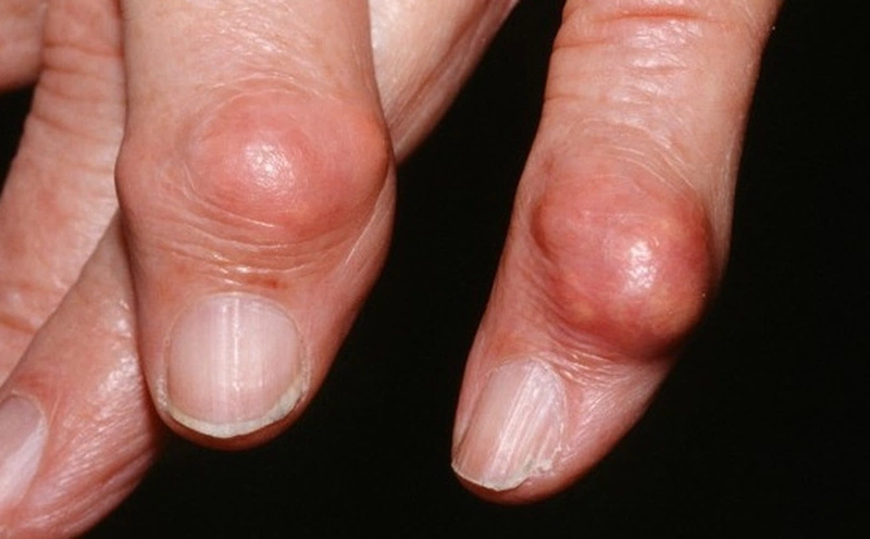 Làm thế nào để kiểm soát chỉ số bệnh gout? 2
