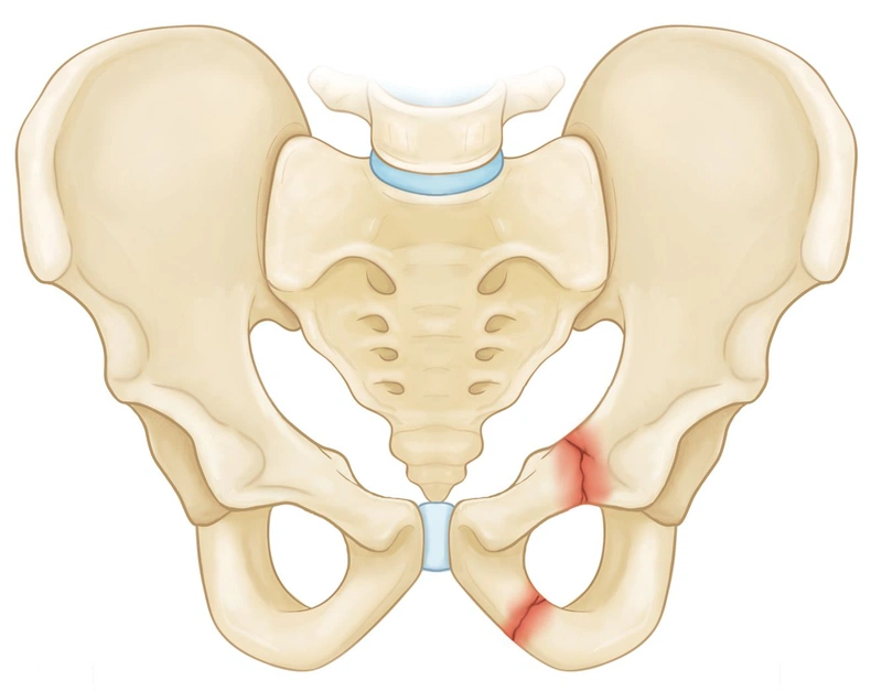Cách phục hồi chức năng gãy xương chậu 1