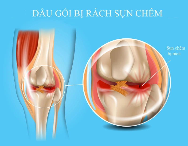 Phục hồi sau phẫu thuật sụn chêm1