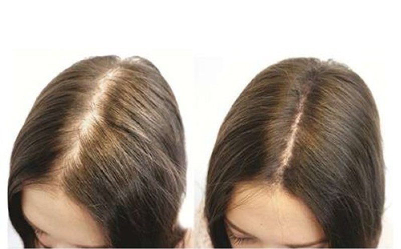  Đặc biệt sau khi cấy tóc, bạn nhớ phải có sự theo dõi của bác sĩ