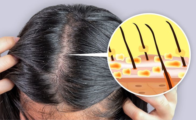 Phương pháp chăm sóc tóc gàu đúng cách giúp đánh bay gàu hiệu quả 3
