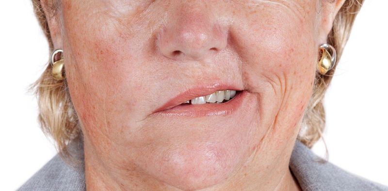 Phương pháp chữa méo miệng liệt mặt