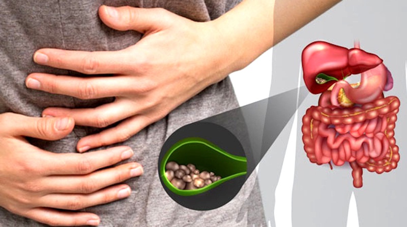 Khi gan tiết ra quá nhiều cholesterol mà mật không thể hòa tan, lượng cholesterol dư thừa có thể kết tinh và tạo thành sỏi