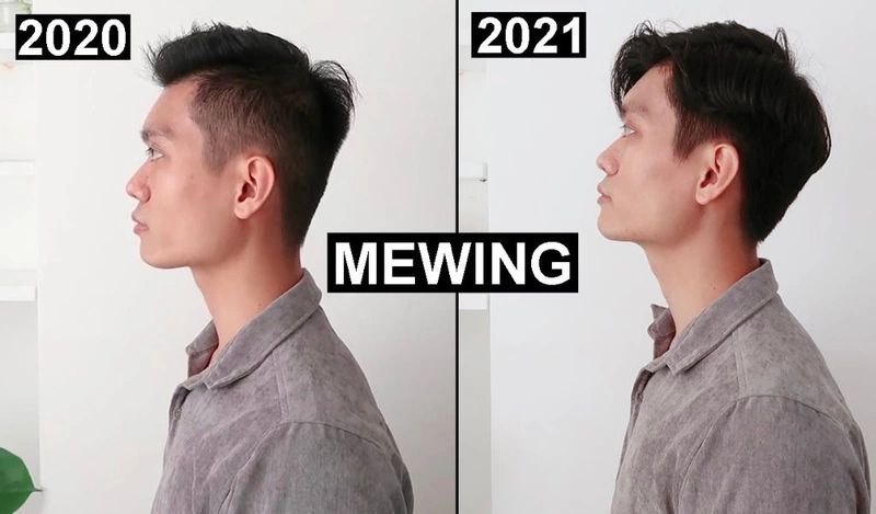 Phương pháp Mewing là gì? Tập mewing có tác dụng gì với khuôn mặt? 1