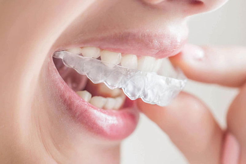 Tìm hiểu về phương pháp niềng răng không mắc cài 3d clear  1