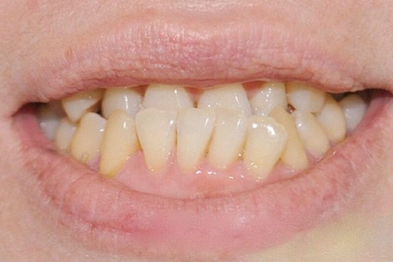 Tìm hiểu về phương pháp niềng răng không mắc cài 3d clear  2