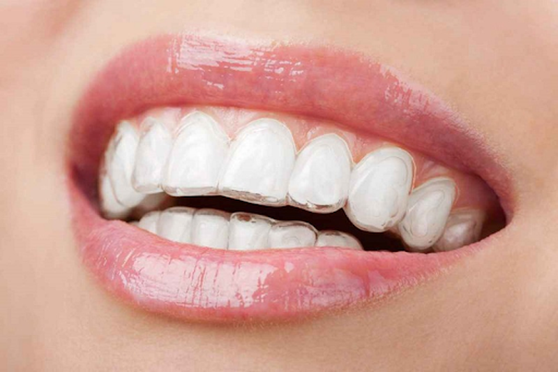 Tìm hiểu về phương pháp niềng răng không mắc cài 3d clear 3