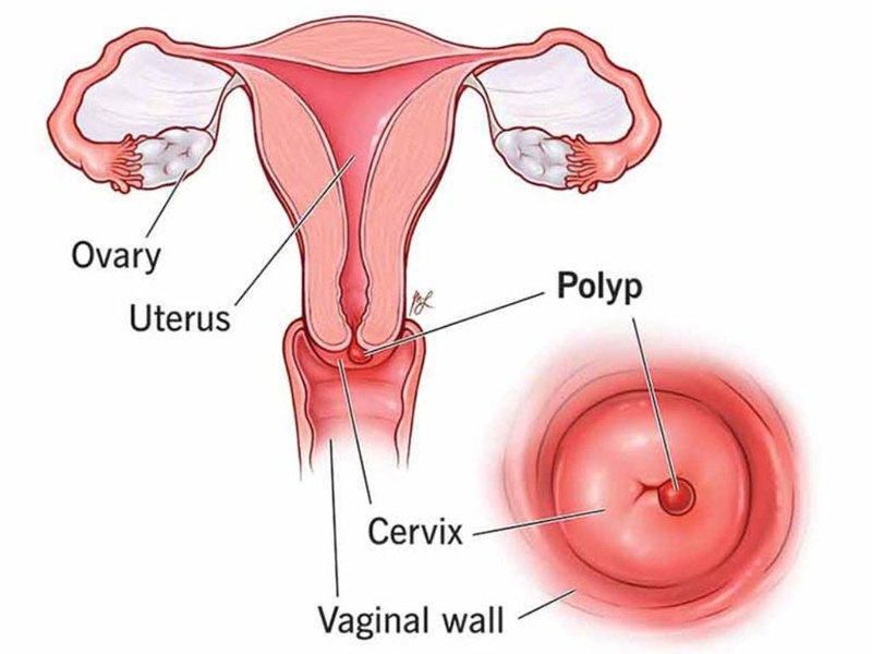 Phương pháp nong cổ tử cung là gì? Lưu ý khi thực hiện thủ thuật nong cổ tử cung 1