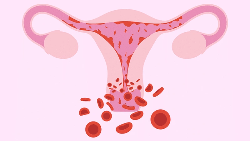 Polyp cổ tử cung bị hoại tử khi mang thai nguy hiểm như thế nào? 1