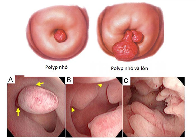 Polyp cổ tử cung gây chảy máu khi mang thai có nguy hiểm không ...