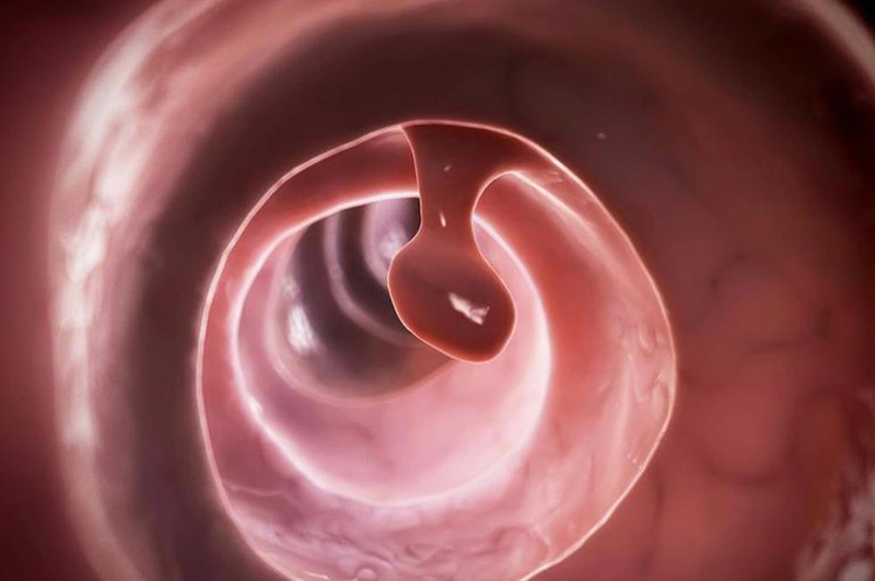 Polyp tử cung có mang thai được không? 3
