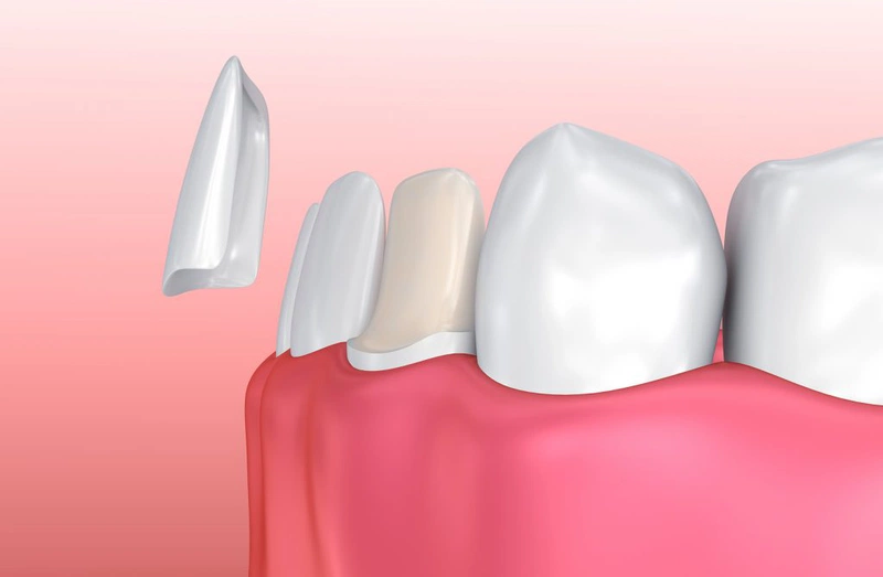 Giải đáp thắc mắc: Dán sứ veneer có ảnh hưởng gì không? 2