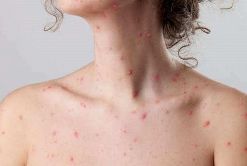 Quá trình của thủy đậu và những điều cần lưu ý trong điều trị 2