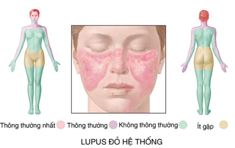 Quá trình lupus ban đỏ thường xuất hiện triệu chứng nào? 4 thực phẩm người mắc bệnh lupus ban đỏ nên tránh xa 2