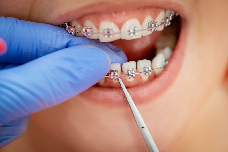 Quá trình niềng răng diễn ra như thế nào? 2