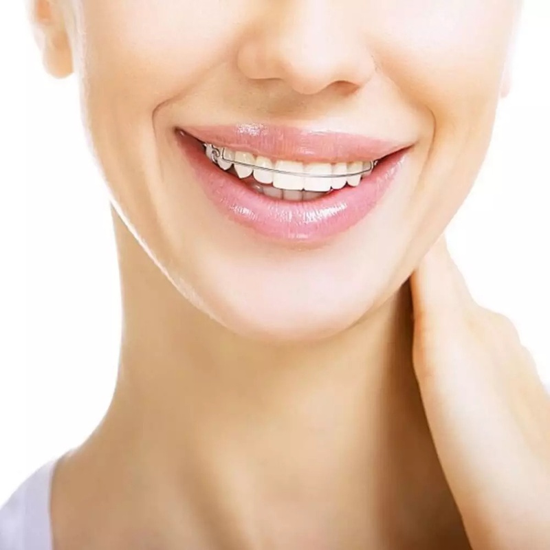 Quá trình niềng răng diễn ra như thế nào? 3