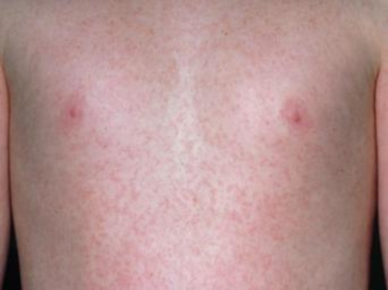 Quá trình phát bệnh sởi diễn ra như thế nào? 2