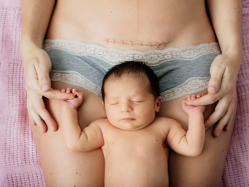 Quá trình sinh mổ như thế nào?3