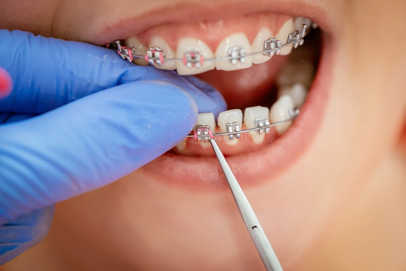 Quy trình niềng răng khớp cắn sâu gồm mấy bước?3