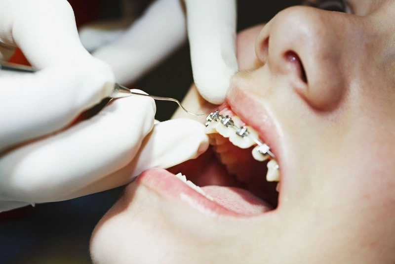 Quy trình tháo niềng răng như thế nào? Cần làm gì sau khi tháo niềng? 1