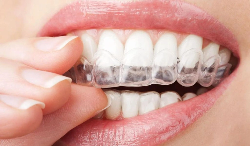 Quy trình tháo niềng răng như thế nào? Cần làm gì sau khi tháo niềng? 2