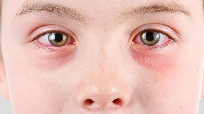 Rách giác mạc có bị mù không? Nên làm gì khi bị rách giác mạc 1
