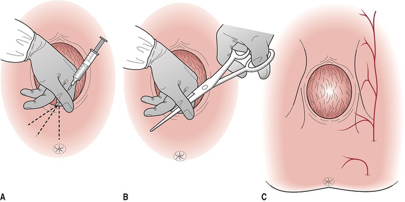 Rạch tầng sinh môn có thể để lại sẹo lồi gây ảnh hưởng đến tâm lý và đời sống sinh hoạt vợ chồng sau này