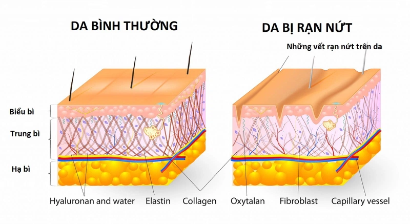 rạn da chân màu đỏ 1