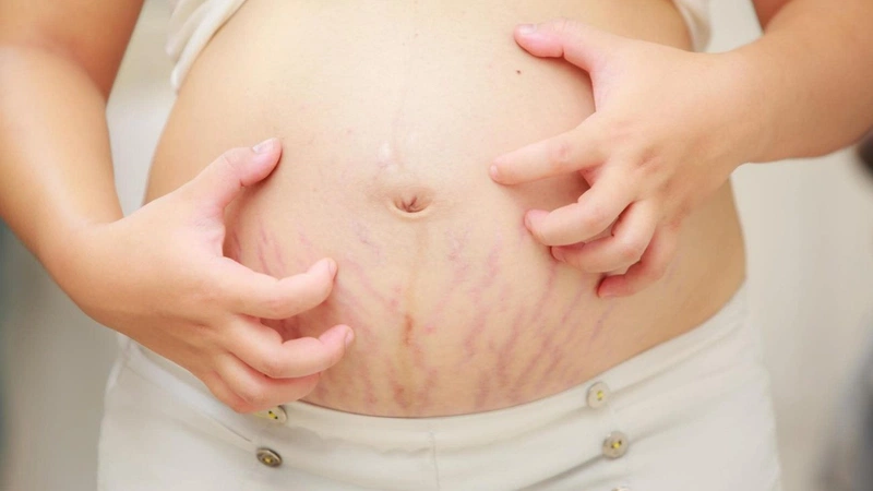 Rạn da đỏ là gì? Rạn da đỏ có tự hết không? 1