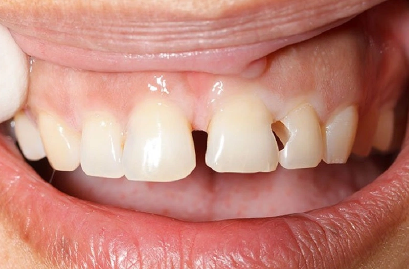 Răng bị mẻ có mọc lại được không trong trường hợp bị mất răng? 1